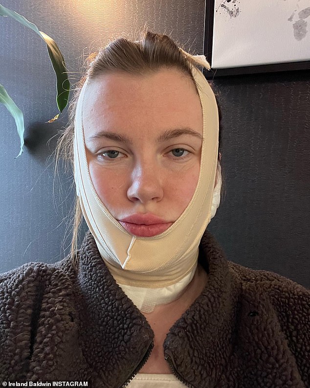 A Cura: Em um novo vídeo do Instagram postado na tarde de terça-feira, a modelo de 26 anos explicou que o FaceTite é um procedimento minimamente invasivo, de uma hora de duração, que nem requer anestesia.